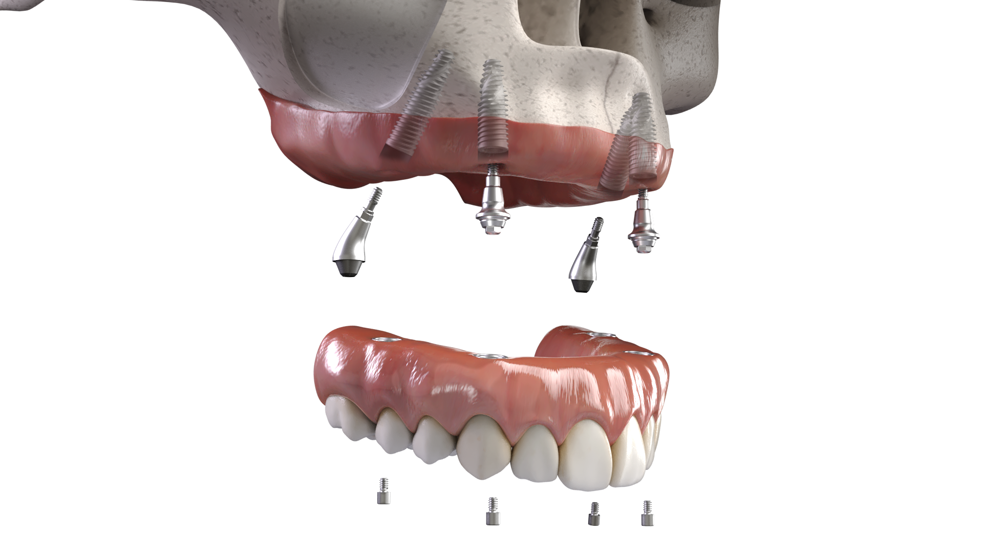 All-on-X hybrid dentures in Miami
