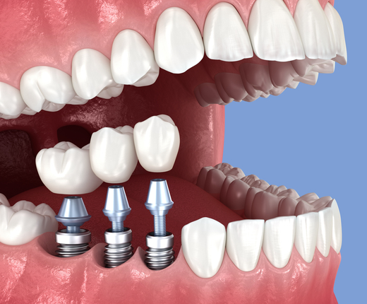 Dental implants treatment