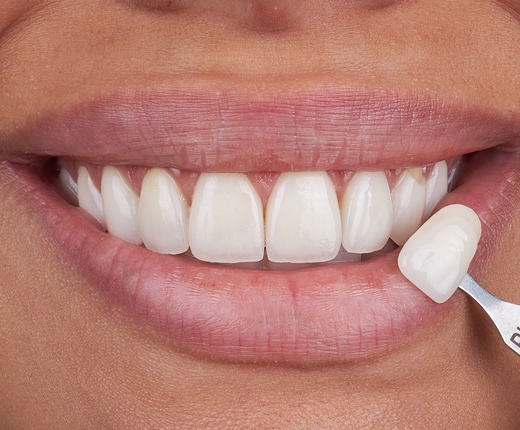 Dental veneers patient smiling