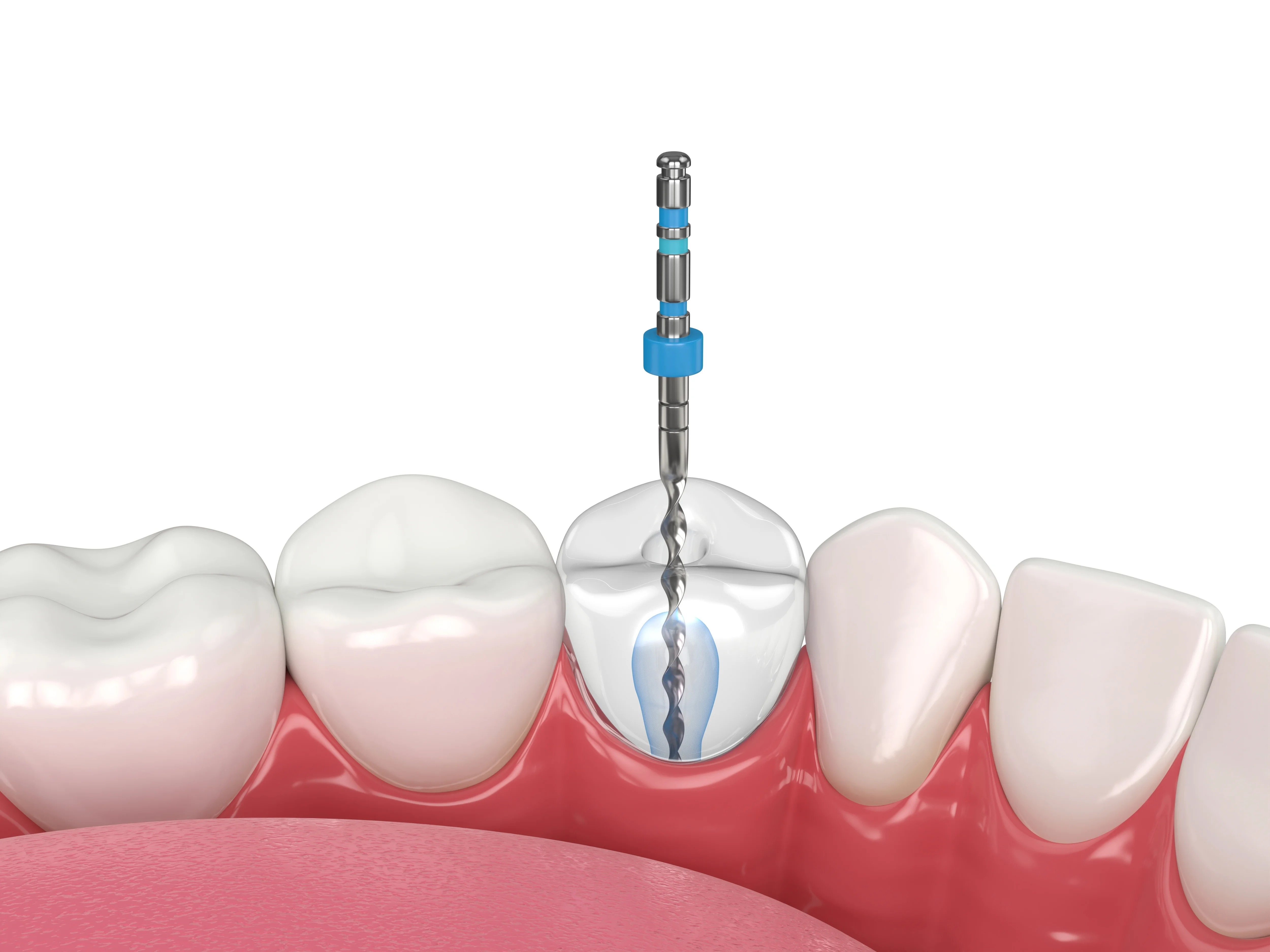 Root canal therapy in Miami